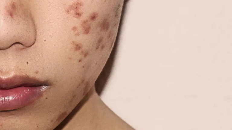 عکس از نیمه صورت دختری که دچار لک پوستی است