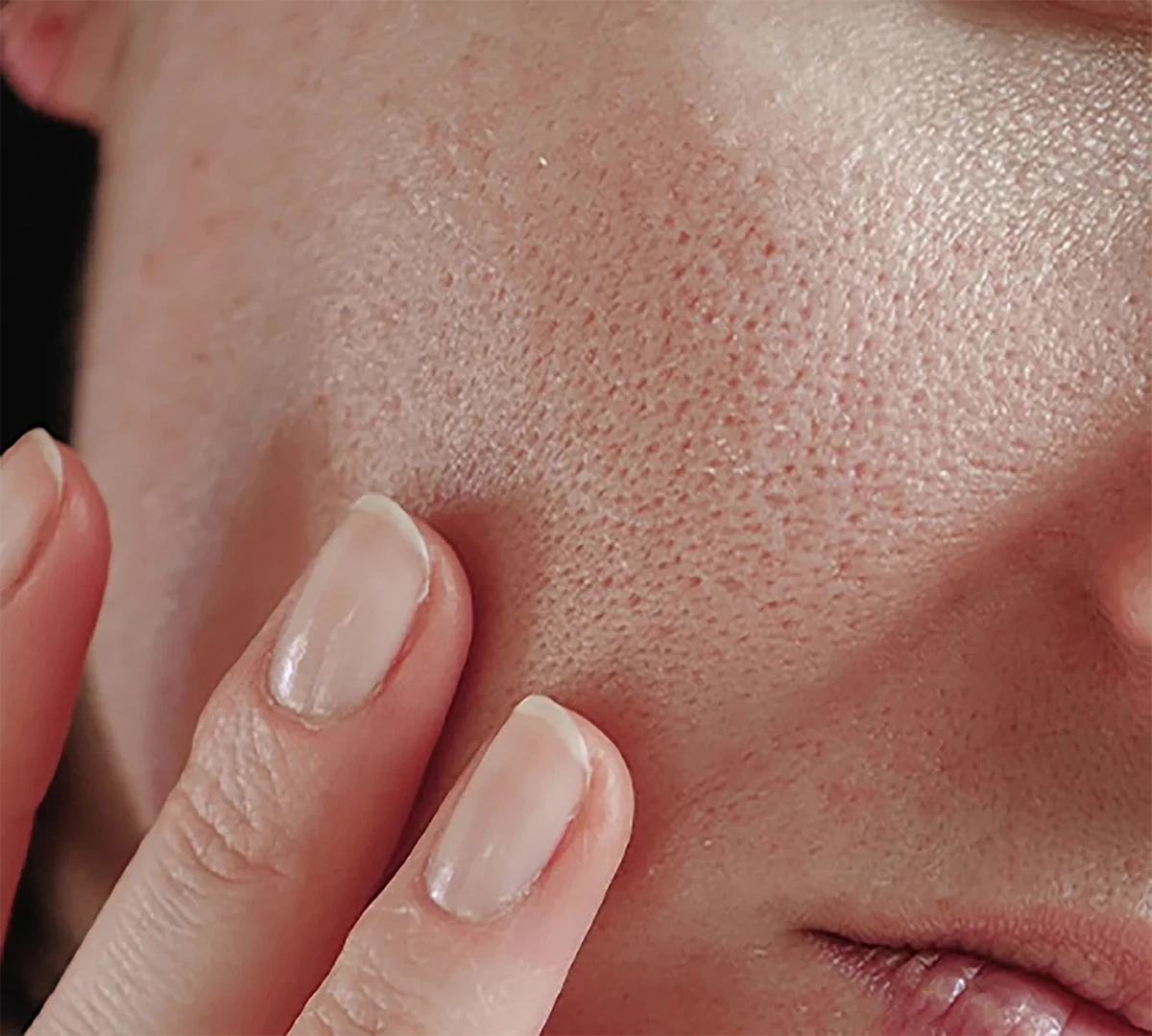 دختری که دستش را روی پوست صورتش گرفته است و منافذ پوست او بسیار بزرگ است