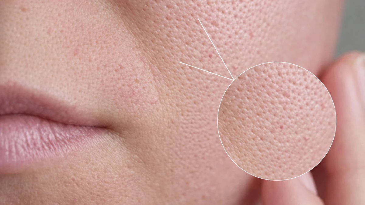 عکس نزدیک از صورت دختری که منافذ صورتش باز است